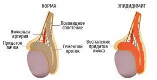 Психосоматика Эпидидимита