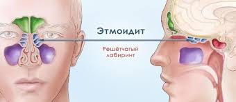 Психосоматика Этмоидит