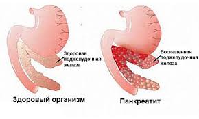 Психосоматика Острого Панкреатита