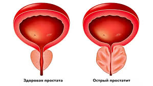 Психосоматика Острый простатит