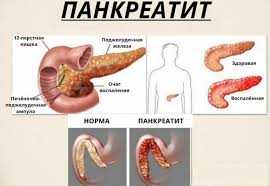 Психосоматика Панкреатита