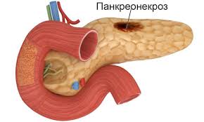 Психосоматика панкреонекроза