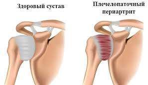 Психосоматика периартрита
