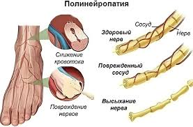 Психосоматика Полинейропатии