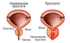 Психосоматика Простатита