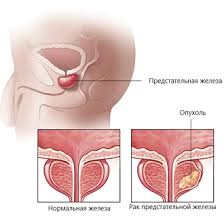 Психосоматика Рак предстательной железы