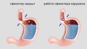 Психосоматика Рефлюкс-эзофагит