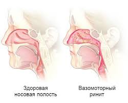 Психосоматика Ринита вазомоторного