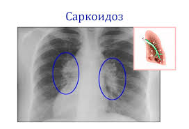 Психосоматика Саркоидоз