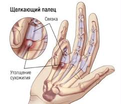 Психосоматика Щелкающий палец