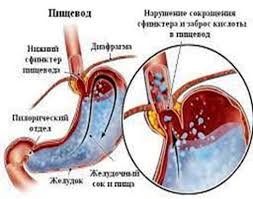 Психосоматика Синдром Мэллори-Вейса