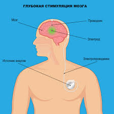 Психосоматика Синдром Туретта