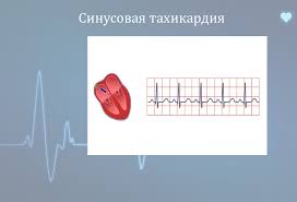 Психосоматика Синусовая тахикардия