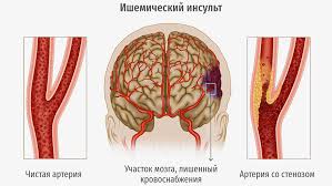 Психосоматика Стеноз артерий