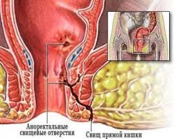 Психосоматика Свищ Прямой Кишки