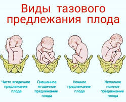Психосоматика Тазовое предлежание плода