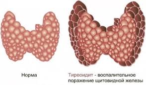 Психосоматика Аутоиммунный тиреоидит