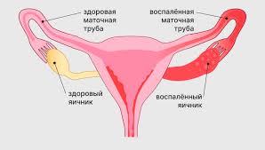 Психосоматика цервицита
