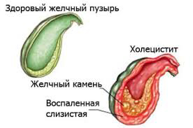Психосоматика Холецистит