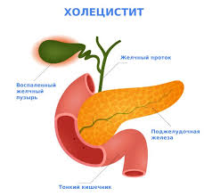 Психосоматика Хронический холецистит