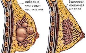 Психосоматика Мастопатии