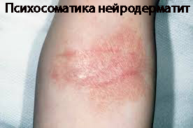 Психосоматика нейродерматит