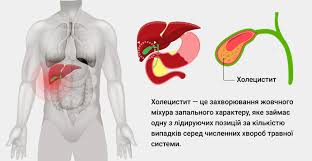 Психосоматика Острый холецистит