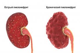 Психосоматика Острый пиелонефрит