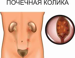 Психосоматика Почечная колика
