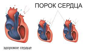 Психосоматика Порок сердца