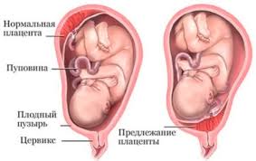 Психосоматика предлежание плаценты