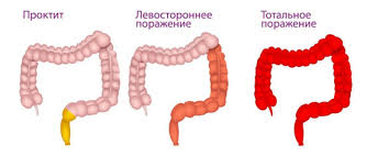 Психосоматика Проктит