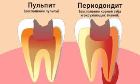 Психосоматика Пульпит