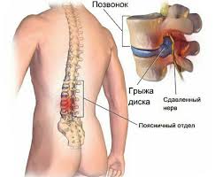 Психосоматика радикулита