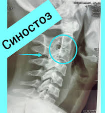 Психосоматика Синостоз