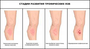 Психосоматика Трофическая язва