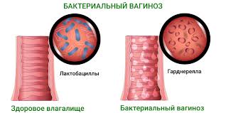 Психосоматика Вагиноз бактериальный