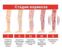 Психосоматика Варикоз