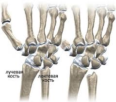 Психосоматика Болезни Кинбека
