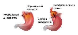Психосоматика диафрагмальной грыжи