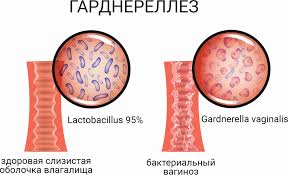 Психосоматика гарднереллеза