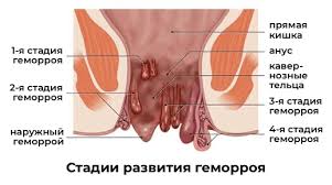Психосоматика Геморроя