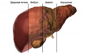 Психосоматика Гепатита С