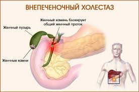 Психосоматика холестаза