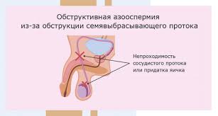 Психосоматика Мужское бесплодие