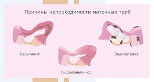 Психосоматика Непроходимость маточных труб