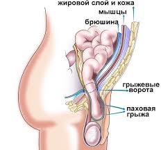 Психосоматика паховой грыжи