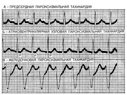 Психосоматика пароксизмальной тахикардии