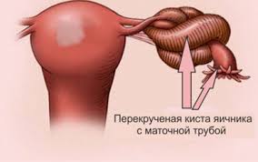 Психосоматика перекрута кисты яичника