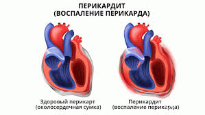 Психосоматика Перикардита